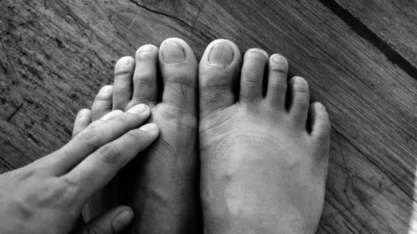 Allt om diabetesfötter – viktig kunskap för dig som är diabetiker